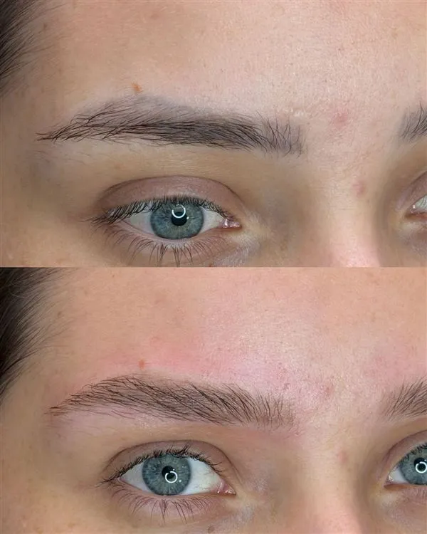 Antes e depois da remoção a laser