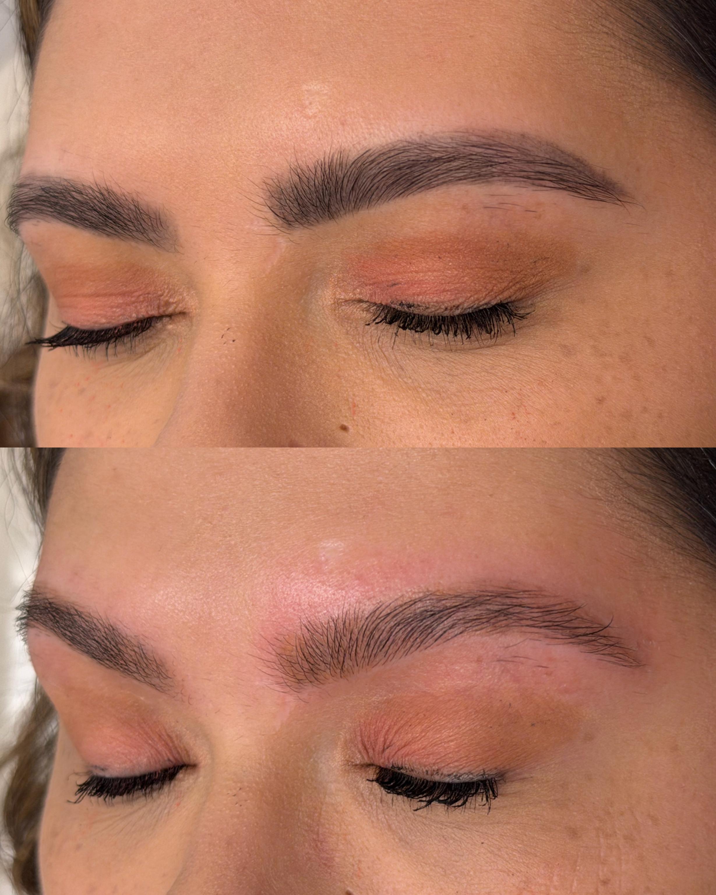 Antes e depois da remoção a laser