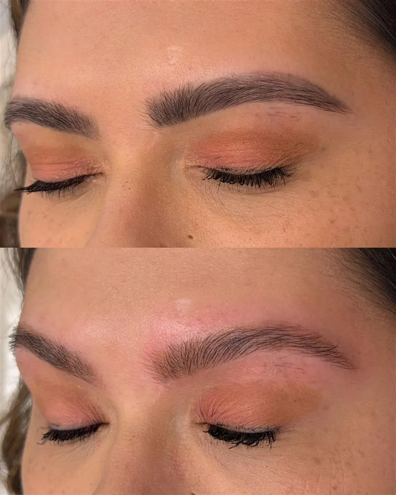 Antes e depois da remoção a laser