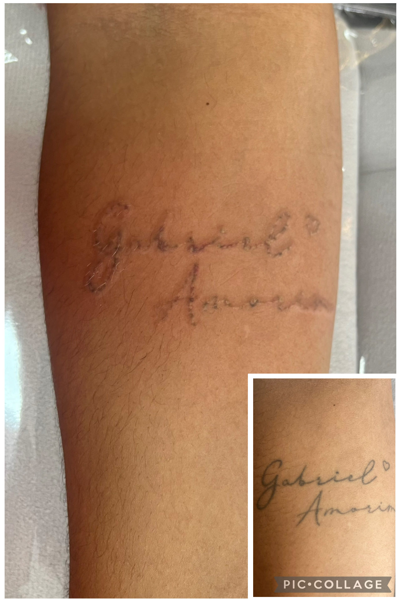 Antes e depois da remoção a laser