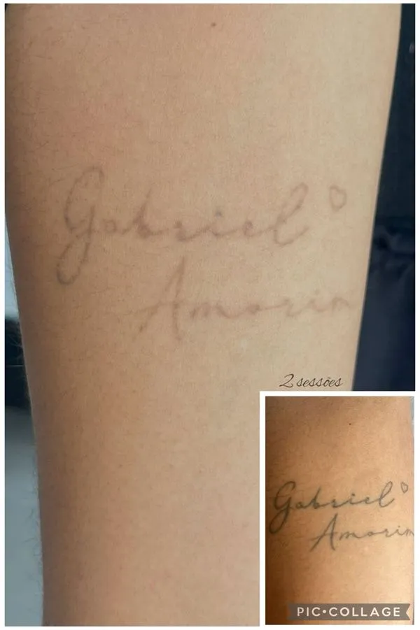 Antes e depois da remoção a laser